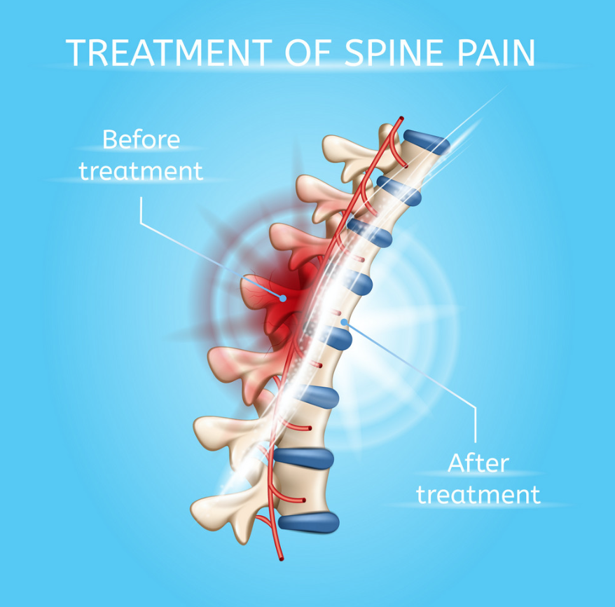 back pain treatments